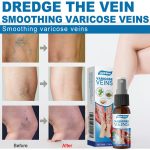 Varicose Veins treatment spray - advanced 50ml formula for spider veins ,leg pain & swelling relief